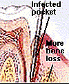 Advanced Periodontal Disease