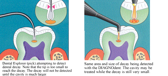 DIAGNOdent graphic